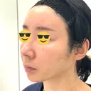 糸リフト / 脂肪吸引（顔） EMMA CLINIC（エマクリニック） BEFORE サムネイル用