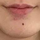 ほくろ・いぼ切除（肌） 大山皮膚科 BEFORE サムネイル用