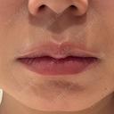 ヒアルロン酸注入（唇） ziz CLINIC BEFORE サムネイル用