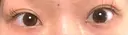 ヒアルロン酸注入（涙袋） 小倉美容外科/美容皮膚科 ビラビューティークリニック BEFORE サムネイル用