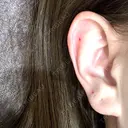 ピアス穴あけ 渋谷美容外科クリニック 新宿院 BEFORE サムネイル用