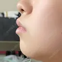 ヒアルロン酸注入（唇） / ボトックス（口角） ルラ美容クリニック 大阪本院 BEFORE サムネイル用