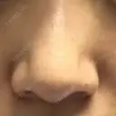 鼻尖形成（切開） リッツ美容外科 大阪院 BEFORE サムネイル用