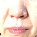 エレクトロポレーション / ルメッカ ON-CLINIC Beauty BEFORE サムネイル用