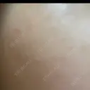 光治療（フォトフェイシャルなど） アクティブエイジクリニック BEFORE サムネイル用