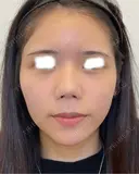 ヒアルロン酸注入（涙袋） / ヒアルロン酸注入（唇） / ヒアルロン酸注入（鼻翼基部） DMTC CLINIC 日本橋院 BEFORE サムネイル用