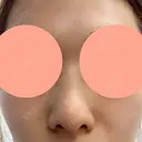 ヒアルロン酸注入（鼻） 博多美容外科/美容皮膚科 ビラビューティークリニック BEFORE サムネイル用