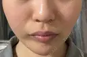 ハイフ（顔） Natural Skin Clinic 自由ヶ丘院 BEFORE サムネイル用