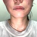 光治療（フォトフェイシャルなど） / RF（高周波）たるみ治療 / ルメッカ / インモード BITO BEAUTY CLINIC BEFORE サムネイル用