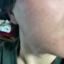 その他（肌） ルラ美容クリニック 大阪本院 BEFORE サムネイル用