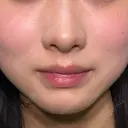 ヒアルロン酸注入（涙袋） / ヒアルロン酸注入（鼻） / ヒアルロン酸注入（あご） / ボトックス（エラ・小顔） / ヒアルロン酸注入（唇） / ヒアルロン酸注入（頬） HAAB×DREAM BEAUTY CLINIC 大阪梅田院 BEFORE サムネイル用