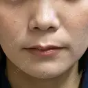 ヒアルロン酸注入（鼻翼基部） / ピーリング（ニキビ・毛穴） ルラ美容クリニック 宇都宮院 BEFORE サムネイル用