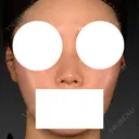 隆鼻術 / 鼻尖形成（切開） / 軟骨移植 / 鼻中隔延長（非切開） X CLINIC 大阪院 BEFORE サムネイル用