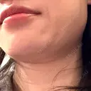 脂肪吸引（顔） プライベートスキンクリニック 梅田本院 BEFORE サムネイル用