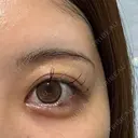 ヒアルロン酸注入（涙袋） ルラ美容クリニック 横浜院 BEFORE サムネイル用