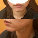 ボトックス（あご） / ボトックス（エラ・小顔） 博多美容外科/美容皮膚科 ビラビューティークリニック BEFORE サムネイル用