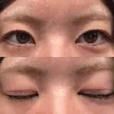 二重埋没 形成外科と美容外科のクリニック池袋 BEFORE サムネイル用