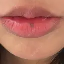 その他（口元） ルラ美容クリニック 大阪心斎橋院 BEFORE サムネイル用