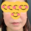 糸リフト / ボトックス（あご） / ヒアルロン酸注入（唇） / ボトックス（眉間） / ボトックス（目尻） eクリニック 那覇院 BEFORE サムネイル用