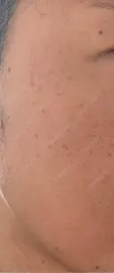 毛穴洗浄（ハイドラフェイシャルなど） / ニードルRF（ポテンツァなど） / ポテンツァ A CLINIC（エークリニック） 新宿院 BEFORE サムネイル用