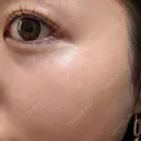 ピーリング（ニキビ・毛穴） / ピーリング（ハリ・ツヤ） / ルメッカ ハナビューティークリニック BEFORE サムネイル用