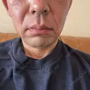 RF（高周波）たるみ治療 plume clinic BEFORE サムネイル用
