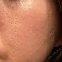 ポテンツァ 大美会クリニック 岡山院 BEFORE サムネイル用