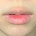 口唇縮小術 / PRP皮膚再生療法 品川美容外科 品川院 BEFORE サムネイル用