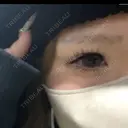 二重埋没 共立美容外科 岡山院 BEFORE サムネイル用