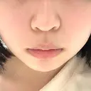 ヒアルロン酸注入（あご） / ボトックス（エラ・小顔） / ヒアルロン酸注入（唇） / ボトックス（口角） ルラ美容クリニック 大阪本院 BEFORE サムネイル用