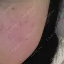 美肌レーザー / シミ取りレーザー / 美白レーザー 銀座みゆき通り美容外科 大阪梅田院 BEFORE サムネイル用