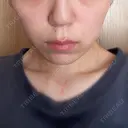 インモード TUNE CLINIC【チューンクリニック】 BEFORE サムネイル用