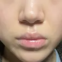 ボトックス（口角） / ヒアルロン酸注入（鼻翼基部） ルラ美容クリニック 大阪本院 BEFORE サムネイル用