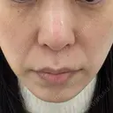 ピコレーザートーニング（美白・肝斑） APスキンクリニック銀座 BEFORE サムネイル用