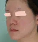 隆鼻術 / 鼻尖形成（切開） / 鼻中隔延長（切開） / 軟骨移植 / 骨切幅寄せ / 鼻孔縁挙上 / 鼻翼基部形成（貴族手術） / 鼻柱下降・鼻唇角形成（猫手術） WOM CLINIC GINZA （ワム クリニック ギンザ） BEFORE サムネイル用