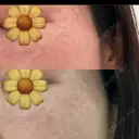 スネコス Natural Skin Clinic 自由ヶ丘院 BEFORE サムネイル用