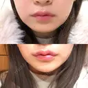 ヒアルロン酸注入（あご） / ヒアルロン酸注入（唇） / ボトックス（口角） ルラ美容クリニック 大阪本院 BEFORE サムネイル用