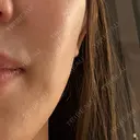 水光注射（ハリ・美肌） CHARIS BEAUTY CLINIC BEFORE サムネイル用