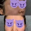 脂肪注入（肌） / 脂肪注入（額） ルラ美容クリニック 岡山院 BEFORE サムネイル用