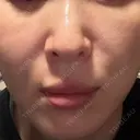 スネコス ミニマムスキンクリニック池袋 BEFORE サムネイル用