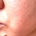 ピコレーザートーニング（美白・肝斑） エトワールレジーナクリニック新宿院 BEFORE サムネイル用