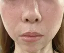 ピコレーザートーニング（美白・肝斑） 白金ビークリニック 本院 BEFORE サムネイル用