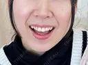 ほくろ・いぼ除去レーザー（肌） Fellez Clinic【フェルズクリニック】 BEFORE サムネイル用