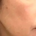 プラセンタ注射 / シミ取りレーザー S-Laboクリニック 渋谷院 BEFORE サムネイル用