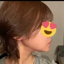 ハイフ（顔） HINATA クリニック BEFORE サムネイル用