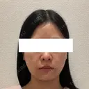 脂肪吸引（顔） ルラ美容クリニック 新宿院 BEFORE サムネイル用
