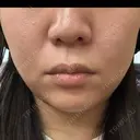 ハイフ（顔） A CLINIC（エークリニック） 新宿院 BEFORE サムネイル用