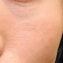 美肌レーザー LEX BEAUTY CLINIC BEFORE サムネイル用