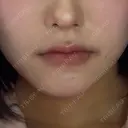 ヒアルロン酸注入（あご） ECLA CLINIC (エクラクリニック) BEFORE サムネイル用