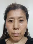 糸リフト / 脂肪吸引（顔） / その他（輪郭） / ジョールファット除去 / 脂肪注入（輪郭） 湘南美容クリニック 秋葉原院 BEFORE サムネイル用